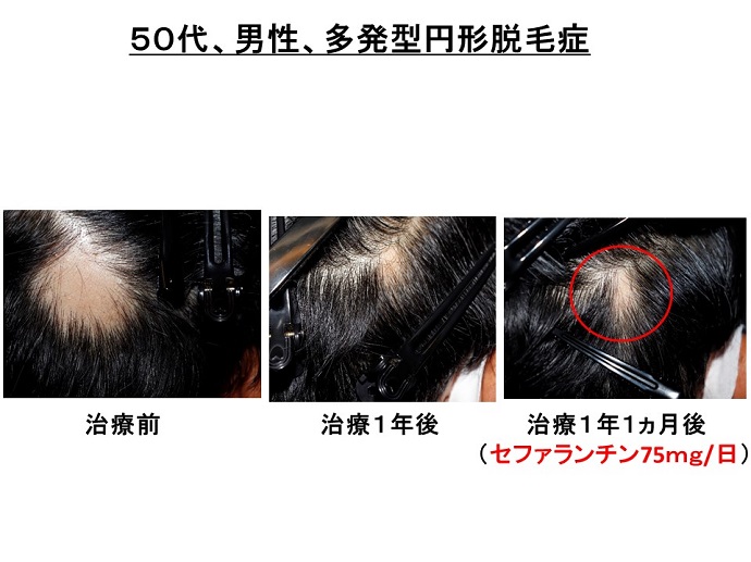 円形脱毛症　病院